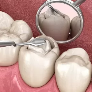 Composite Fillings 4