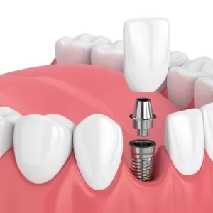 Dental Implants2