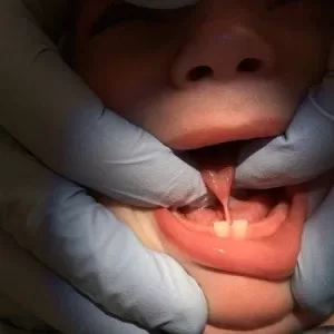 Frenectomy5