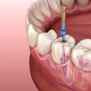 Root-Canal2