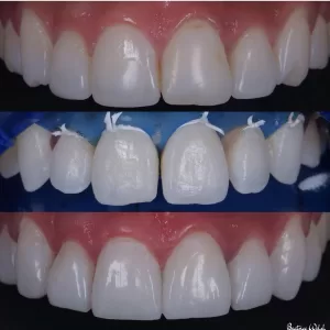 composite veneers 1