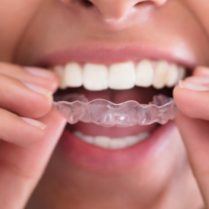 invisible-aligners-side-effects