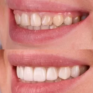 porcelain veneers 1