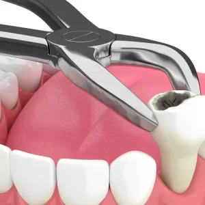 tooth-extraction-dental-service-1024x768